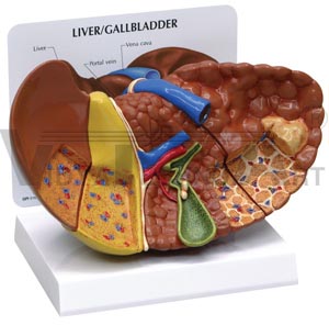 Diseased Liver